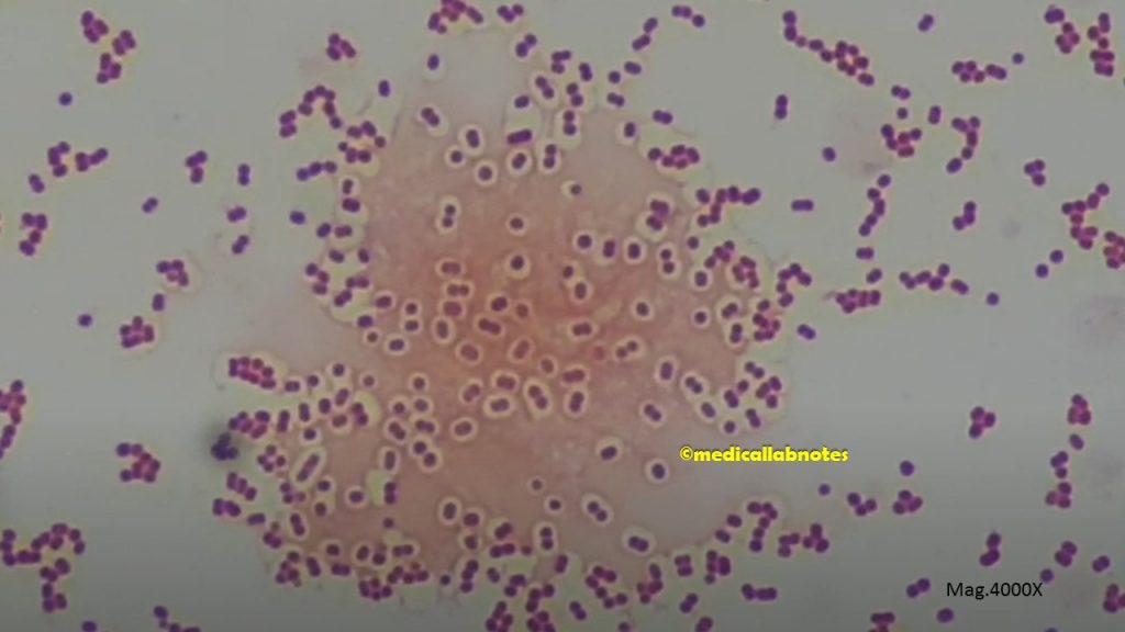 Acinetobacter in Gram stained smear of culture showing capsulated Gram negative coccobacilli