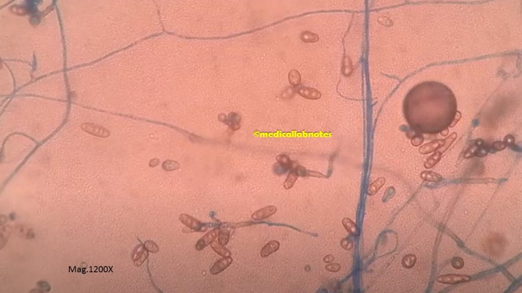 Bipolaris species in LPCB tease mount  showing sympodial development of pale brown pigmented, pseudseptate conidia on a geniculate or zig-zag rachis