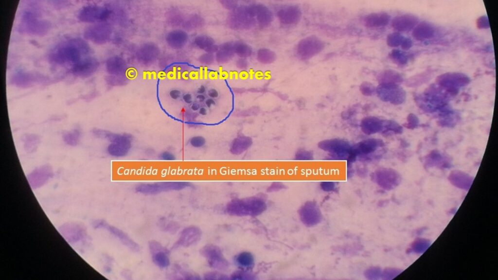 Candida glabrata in Giemsa stained smear of sputum