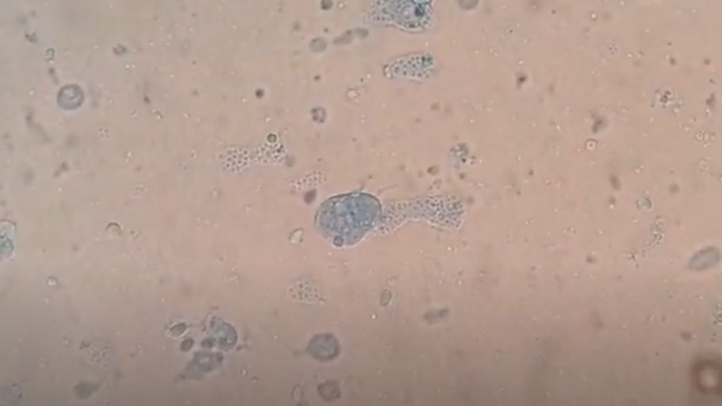 Cyst and trophozoite of Entamoeba histolytica in LPCB wet mount microscopy