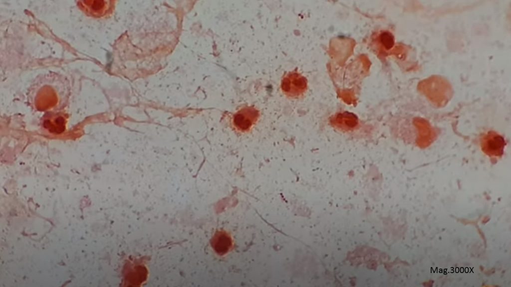 Enterococcus is the etiological agent of pneumonia in Sputum Microscopic Footage showing Gram-positive cocci in singles, pairs, and short chains with numerous pus cells