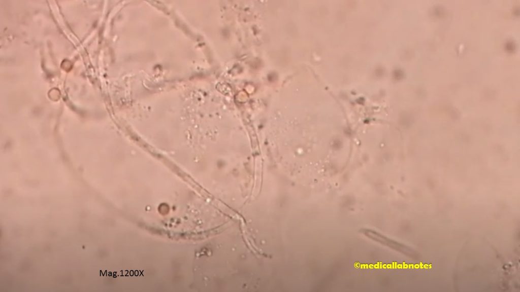 Funagl hyphae and conidia in KOH mount of Pus