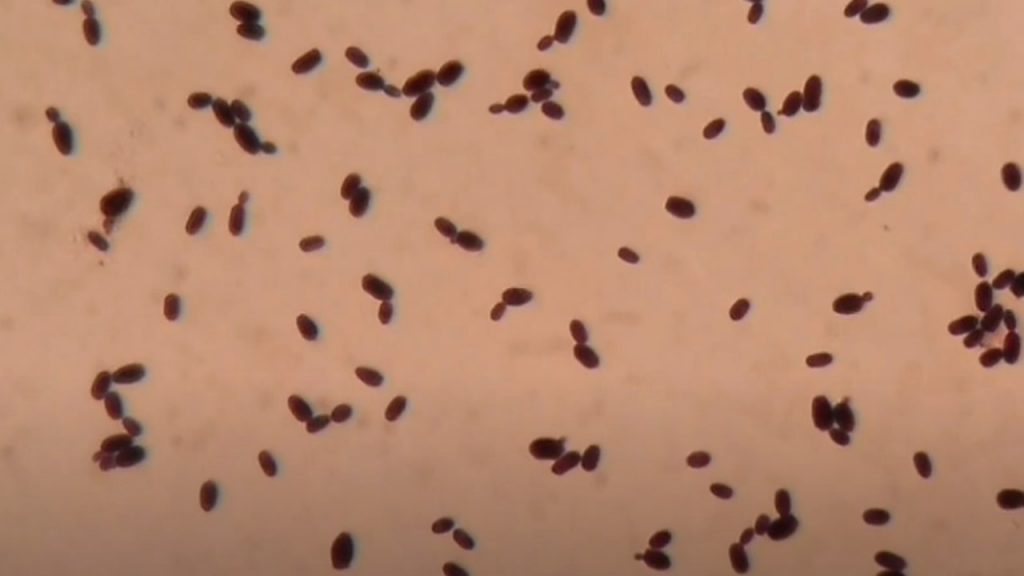 Gram Positive Yeast cells of Candida 