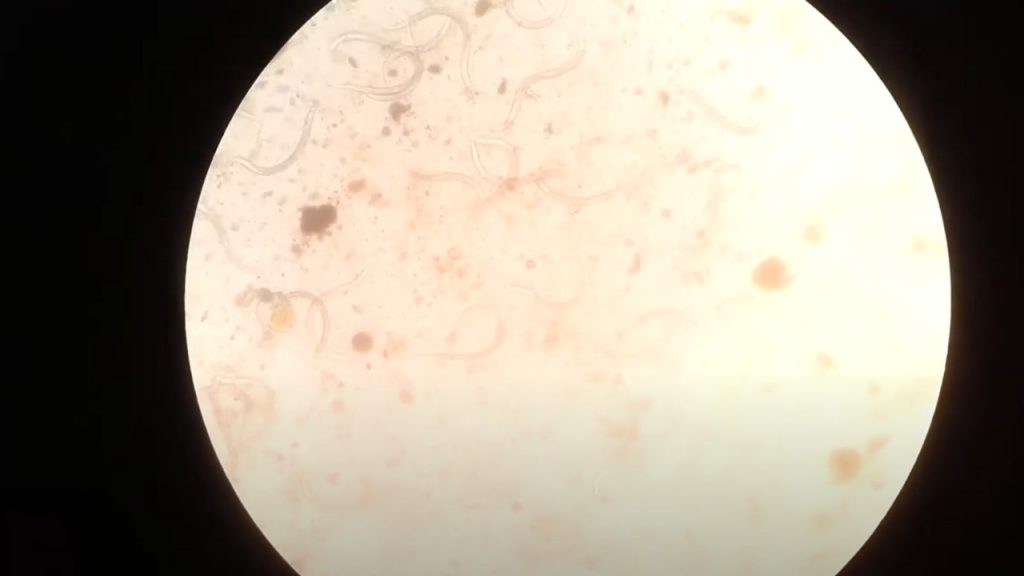 Heavy load of parasites in stool of a patient Microscopy