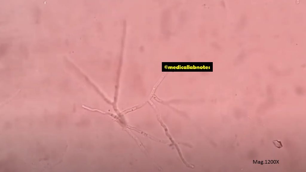 KOH mount of ear discharge showing fungal elements-Septate hyphae with V-shaped or acute-angle or dichotomous branching