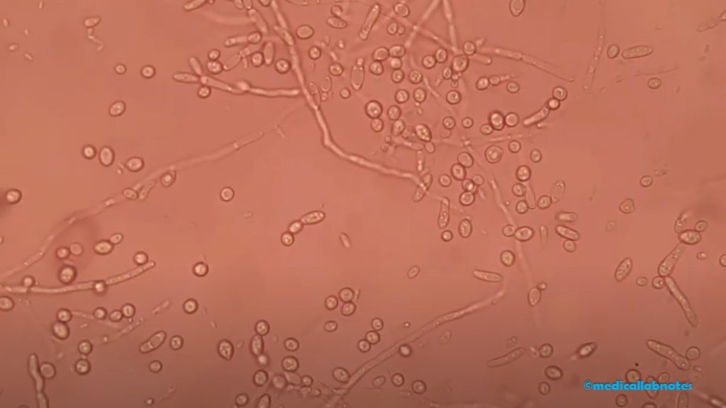 Malassezia in saline wet mount microscopy