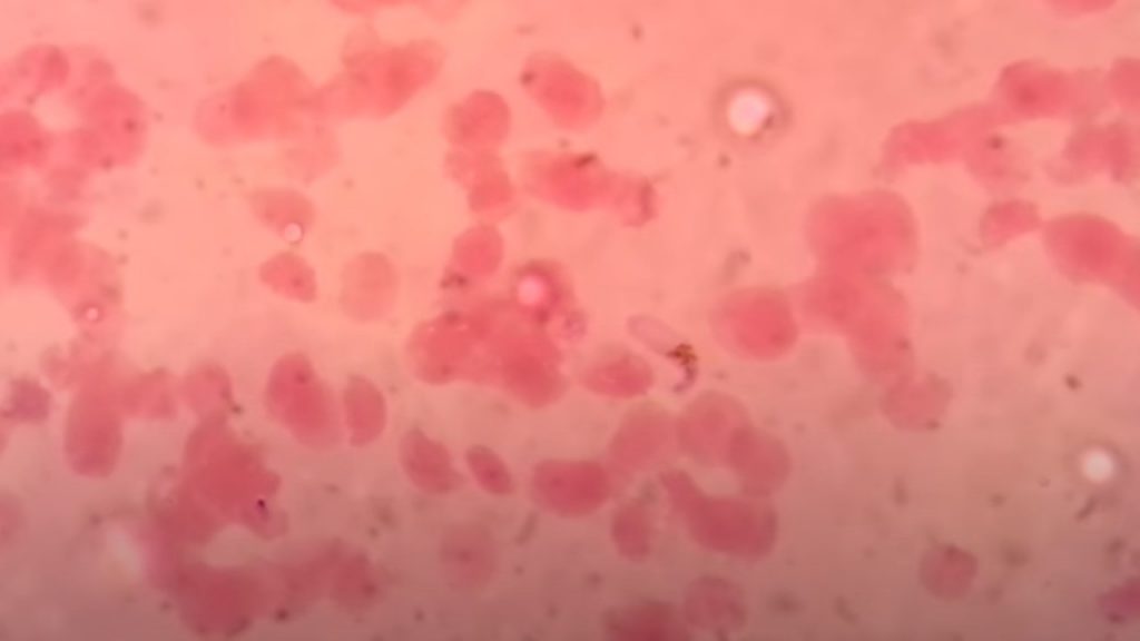 Plasmodium falciparum banana-shaped Gametocyte in thin blood smears