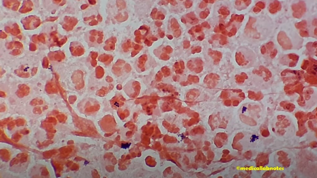 Staphylococcus aureus Gram stain fooatge in  purulent wound drainage