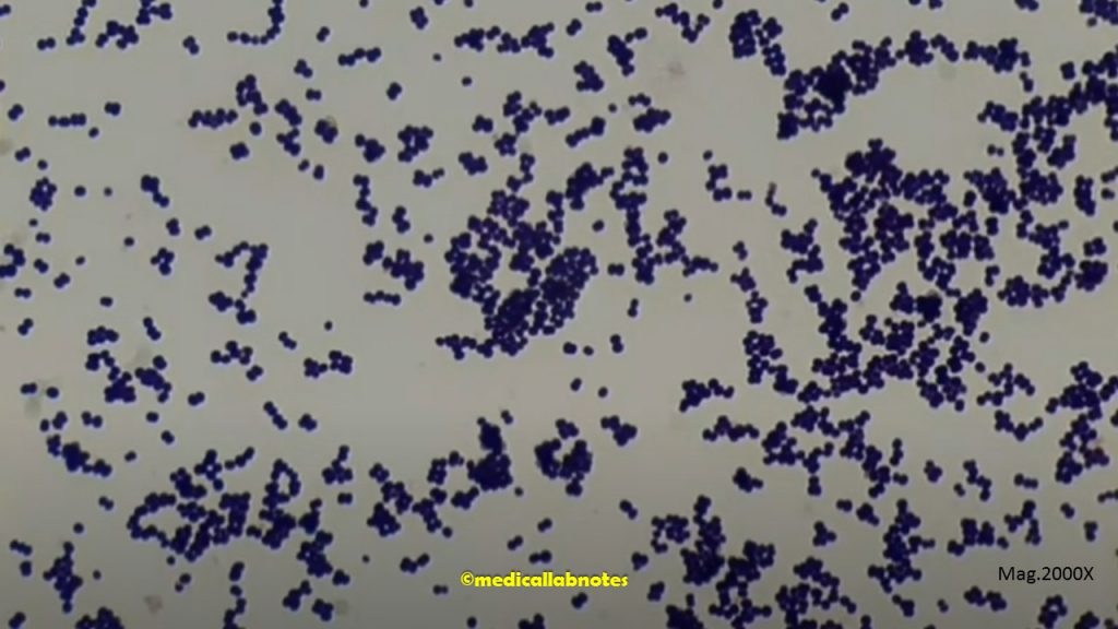 Staphylococcus aureus in Gram stained smear of culture showing Gram positive cocci in singles, pairs and clusters