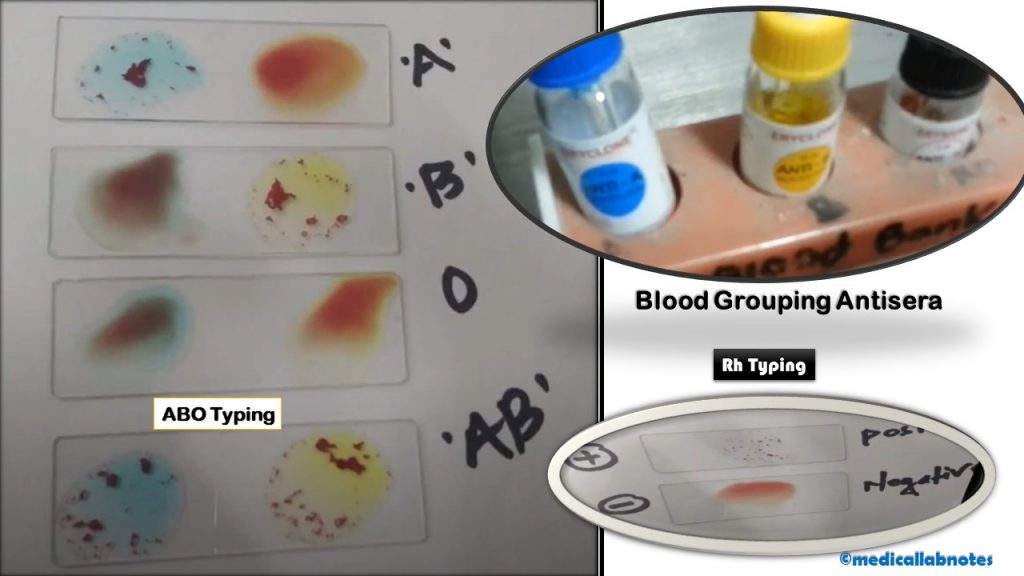 Blood Grouping and Rh Typing: Introduction, Principle, Procedure, Result Interpretation and Keynotes