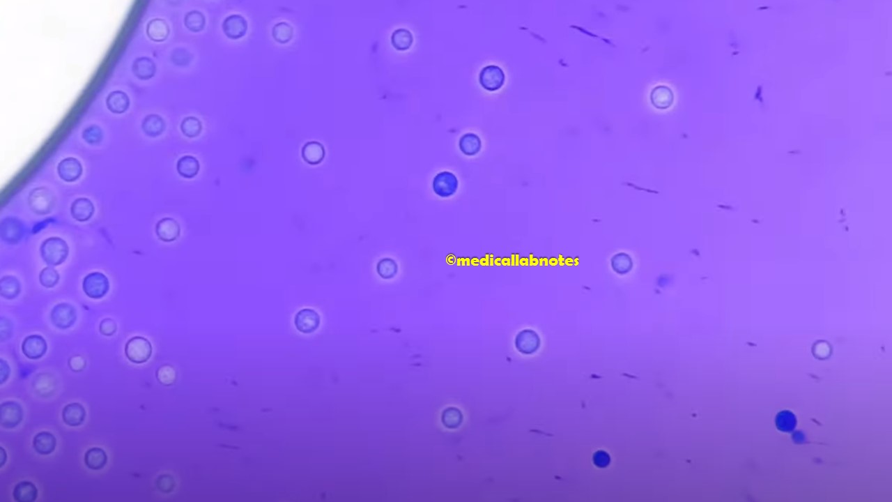 Cryrptococcus neoformans capsules in Methylene blue wet mount Microscopy