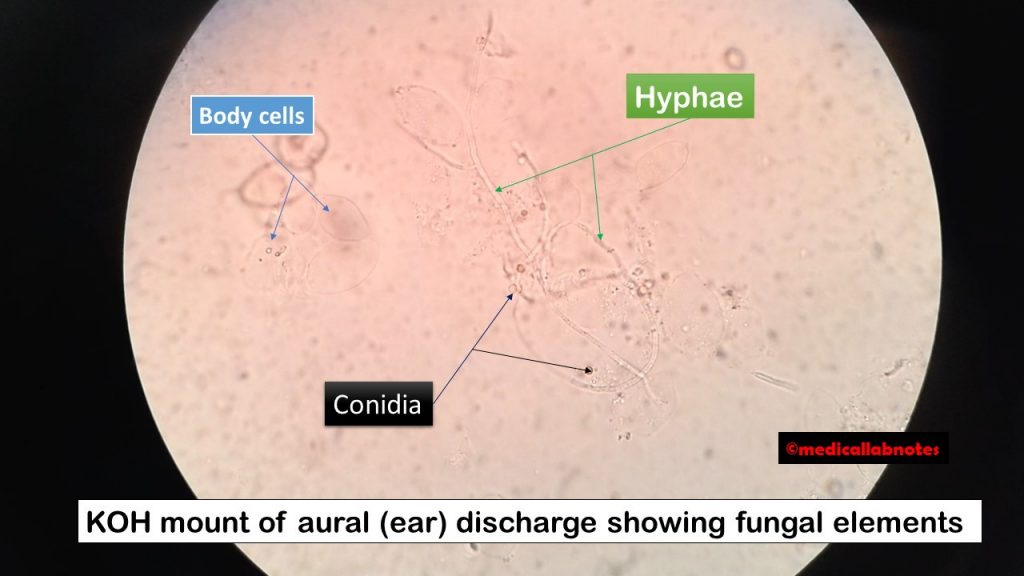KOH mount of aural discharge showing fungal elements-Septate hyphae with V-shaped or acute-angle or dichotomous branching