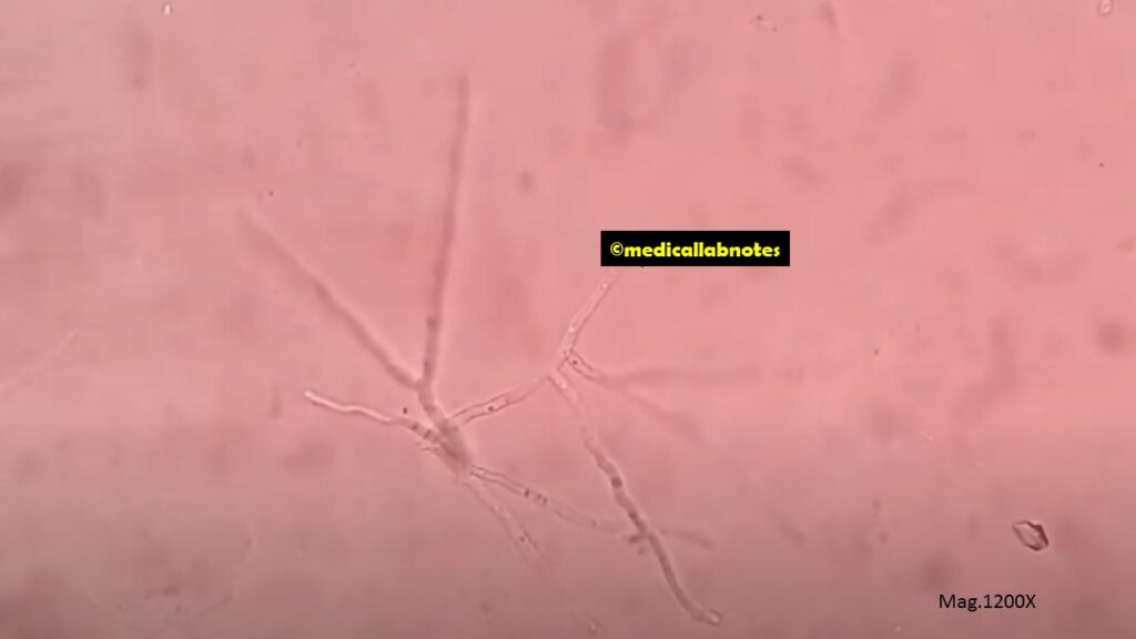 KOH mount of ear discharge showing fungal elements-Septate hyphae with V-shaped or acute-angle or dichotomous branching