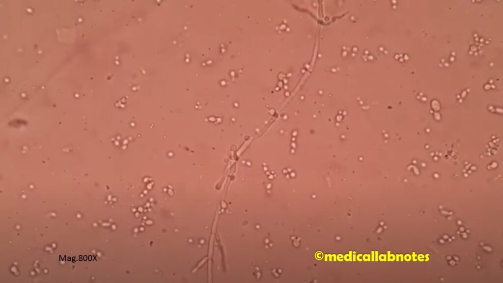 KOH mount of sputum under the Microscope showing fungal elements- yeast cells and fungal hyphae
