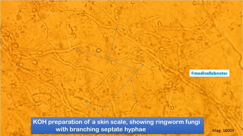 KOH preparation of a skin scale, showing ringworm causing fungus structures