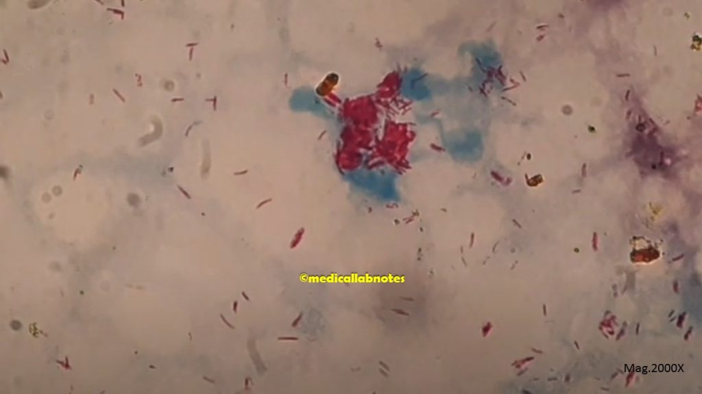 Mycobacterium leprae bacilli in Slit skin smear Microscopy