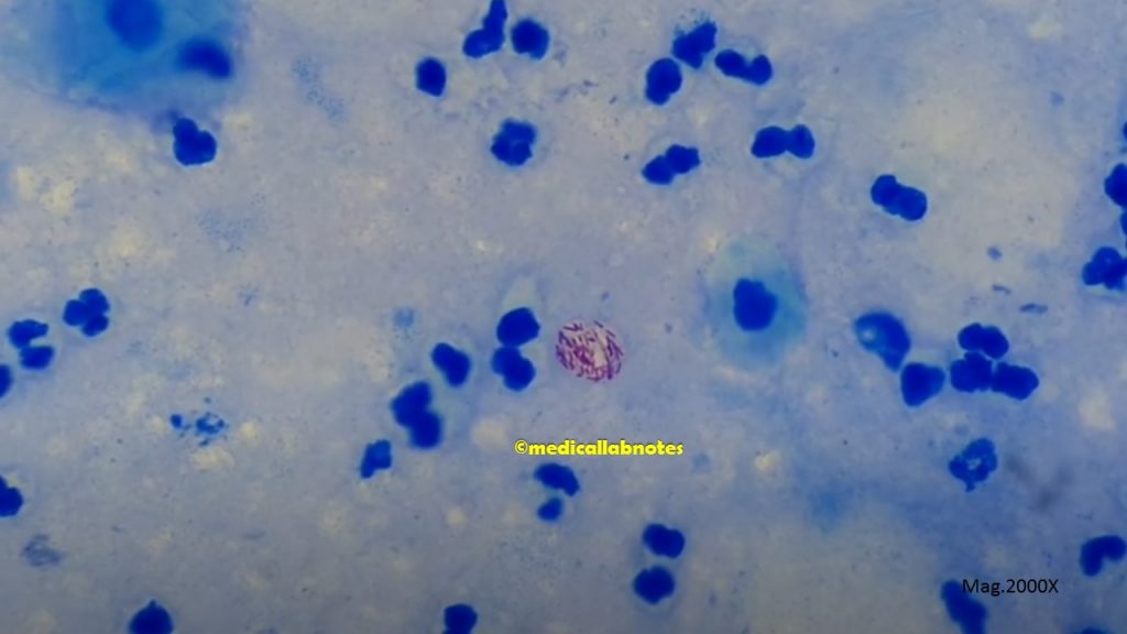 Sputum in Ziehl-Neelsen stained smear exhibiting  Mycobacterium leprae
