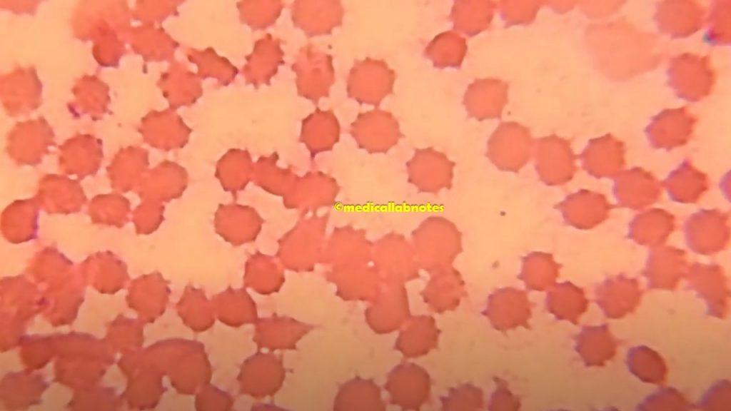Acanthocyte on PBS Demonstration