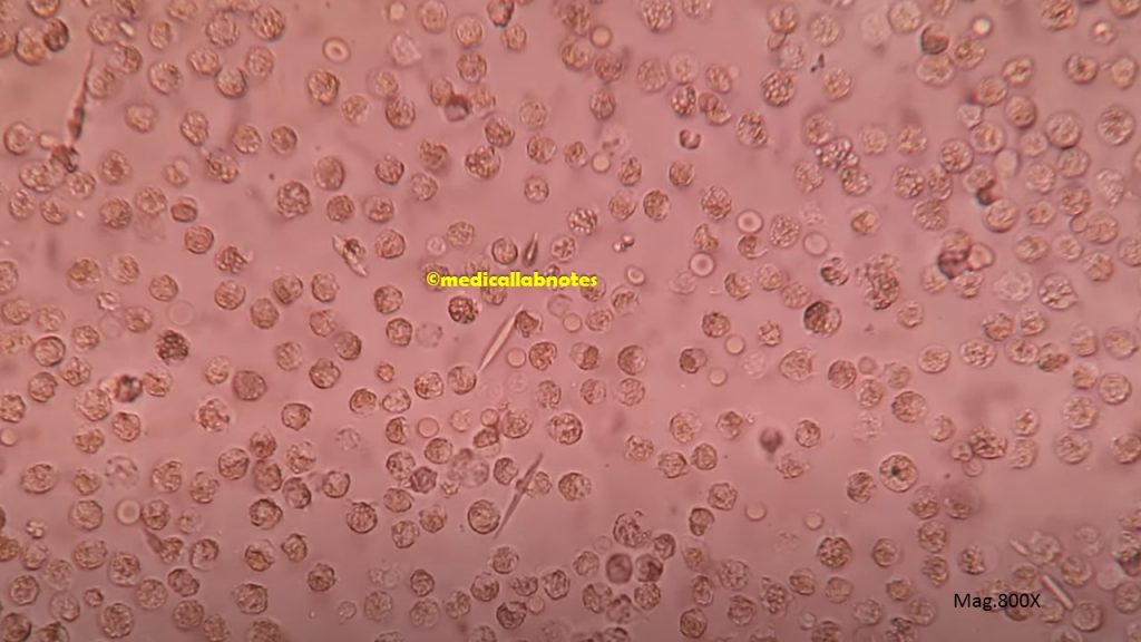 CL Crystals in pleural fluid Microscopy