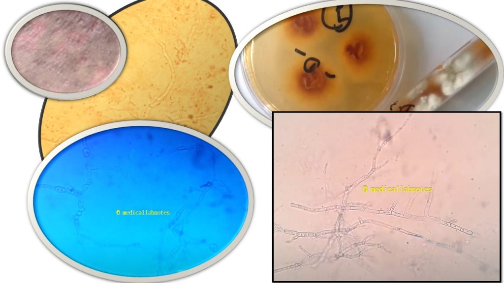 Differences among Trichophyton, Microsporum, and Epidermophyton: Definition, Differences and, Footages of Dermatophytes