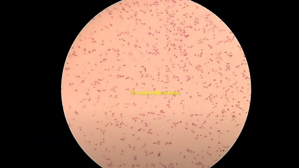 Gram negative diplococci of Neisseria meningitidis in Gram staining of culture