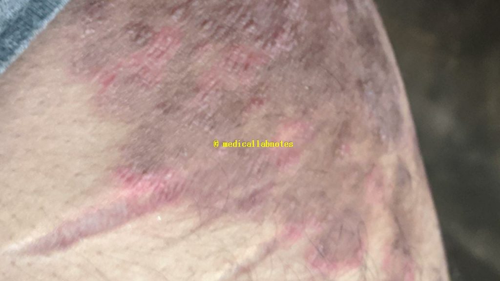 Ringworm in groin region of a patient