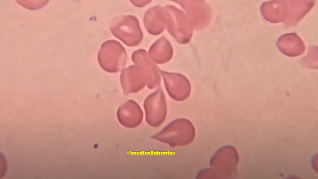 Teardrop cells or Dacrocytes on Wright's stained PBS Demonstration