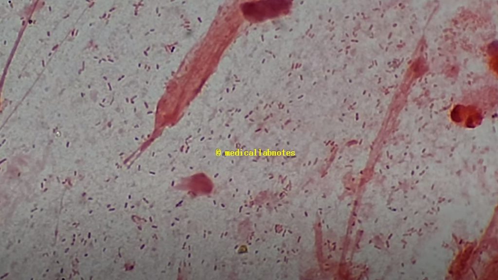 The capsulated strain of Haemophilus influenzae in Gram-staining of sputum showing pleomorphic Gram-negative coccobacilli to small and large rods and bodies surrounded by clear zones at a magnification of 2000X