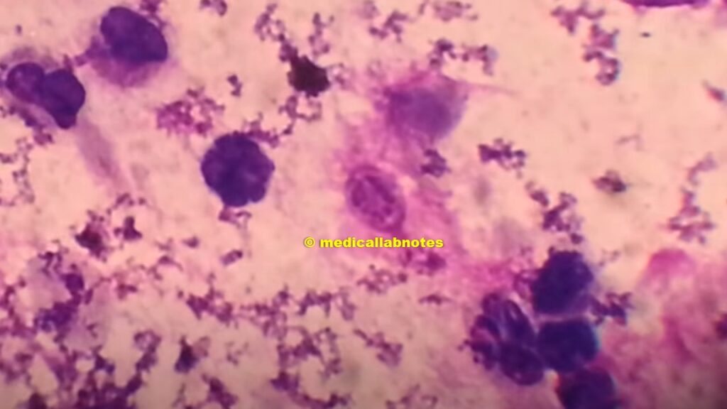 Cyst of Pneumocystis jiroveciin in Giemsa stained smear of BAL showing sporozoites