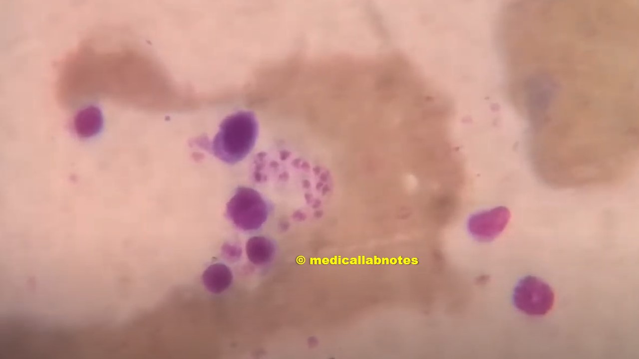 Leishmania donovani (LD bodies) amastigotes in Giemsa stained smear of bone marrow of a Visceral leishmaniasis (VL) or kala-azar patient