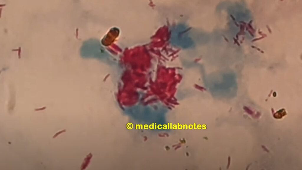 Mycobacterium leprae  in Ziehl-Neelsen staining  of Sputum at a high magnification