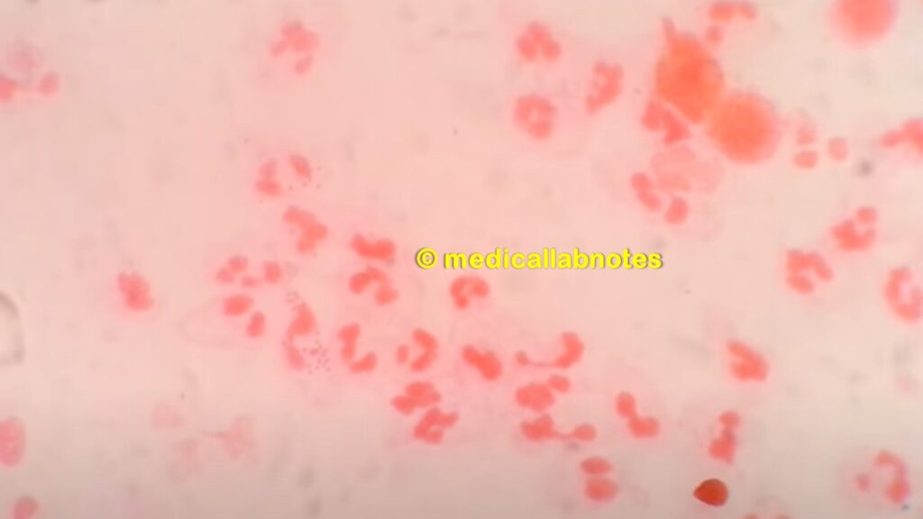 Neisseria gonorrhoeae in Gram staining of urethral discharge showing Gram negative diplococci