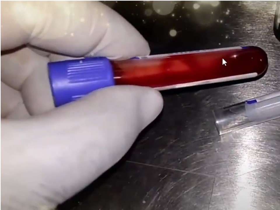 EDTA whole blood for Haematology tests