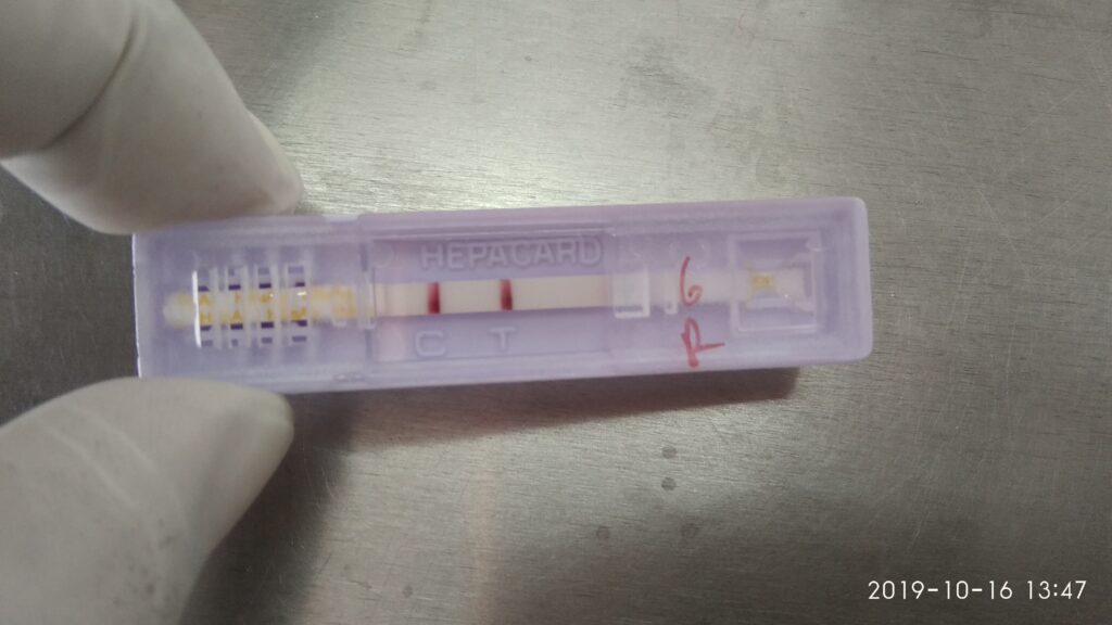 Hepatitis B Surface Antigen (HBsAg) Test-Positive