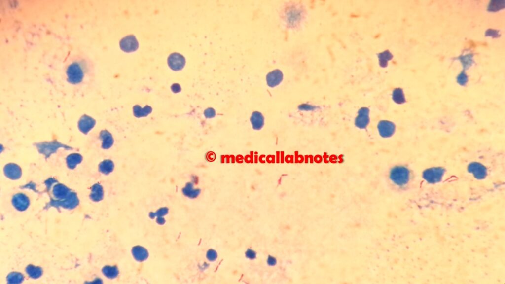 Acid Fast bacilli (AFB) in Ziehl-Neelsen or acid -fast stained smear microscopy