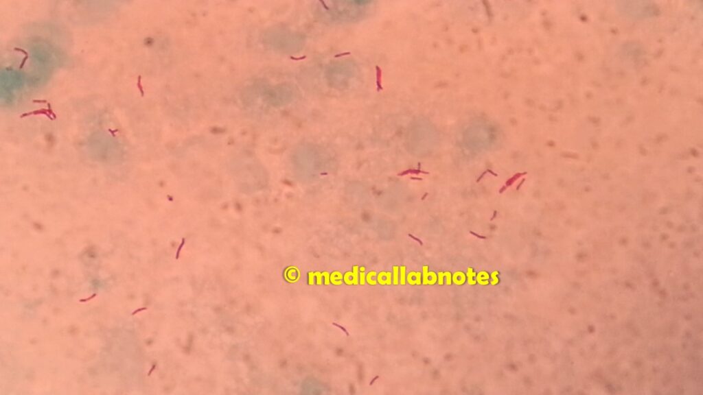 Acid Fast bacilli (AFB)  of Mycobacterium tuberculosis in counter stain Malachite green at a high magnification