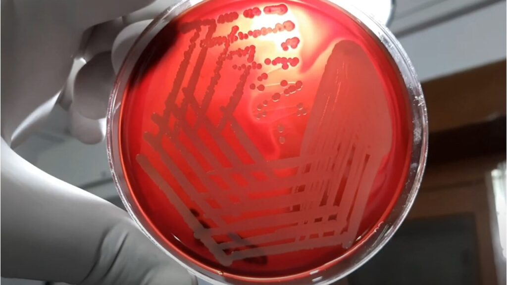 Beta-haemolytic colonies of Staphylococcus aureus on blood agar