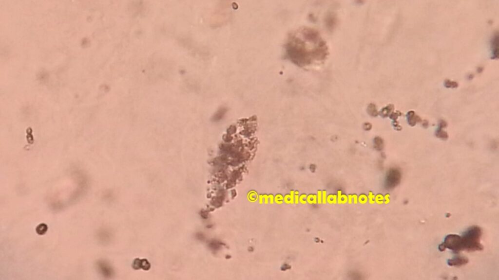 Crystal casts in urine microscopy