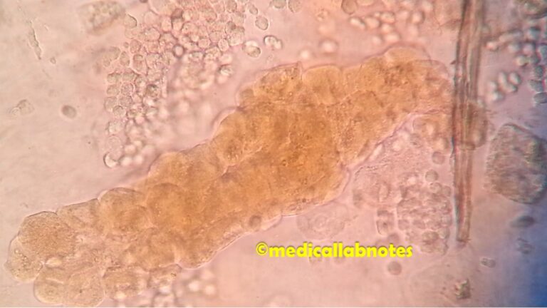 Urine Casts: Introduction, Identification Features, and Clinical