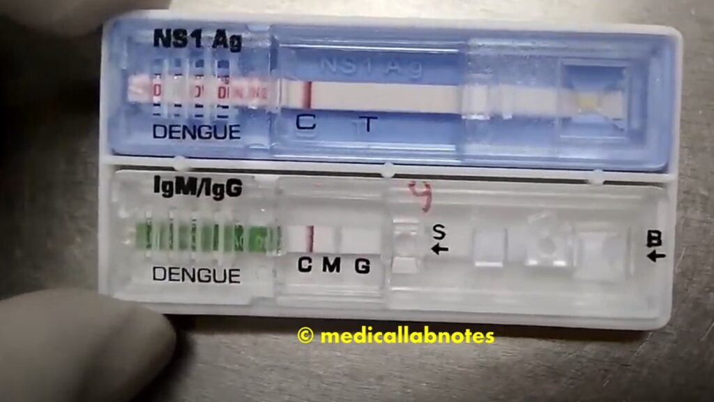 Dengue NS1 antigen-Positive