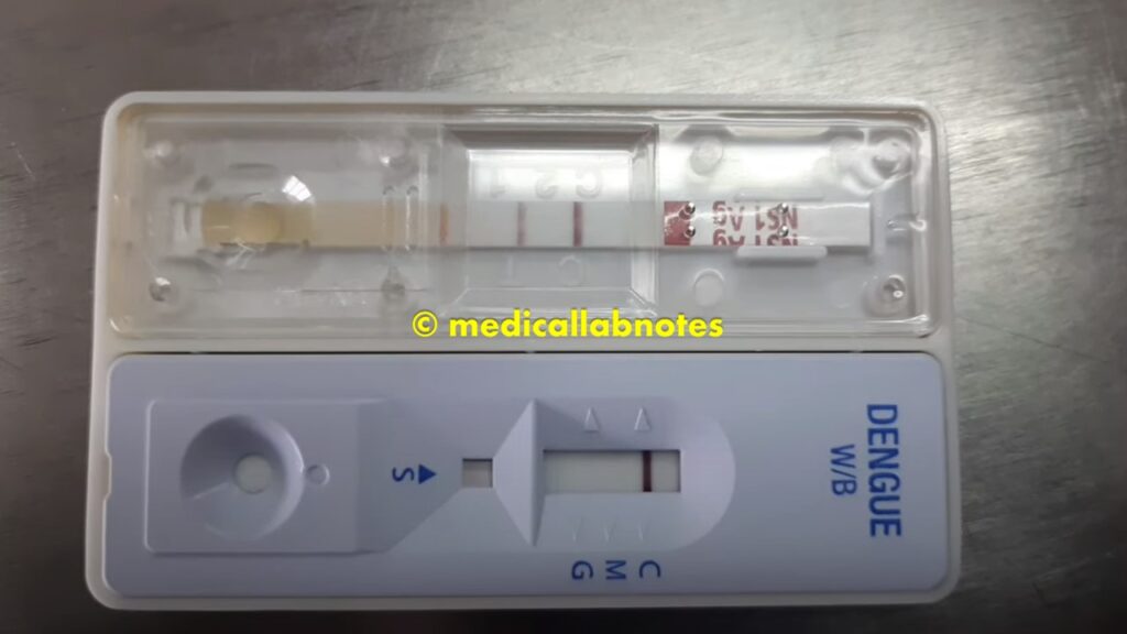 Dengue Rapid Test for IgM, IgG, and NS1 antigen Detection-Test device showing NS1-Positive, IgM and IgG- Negative