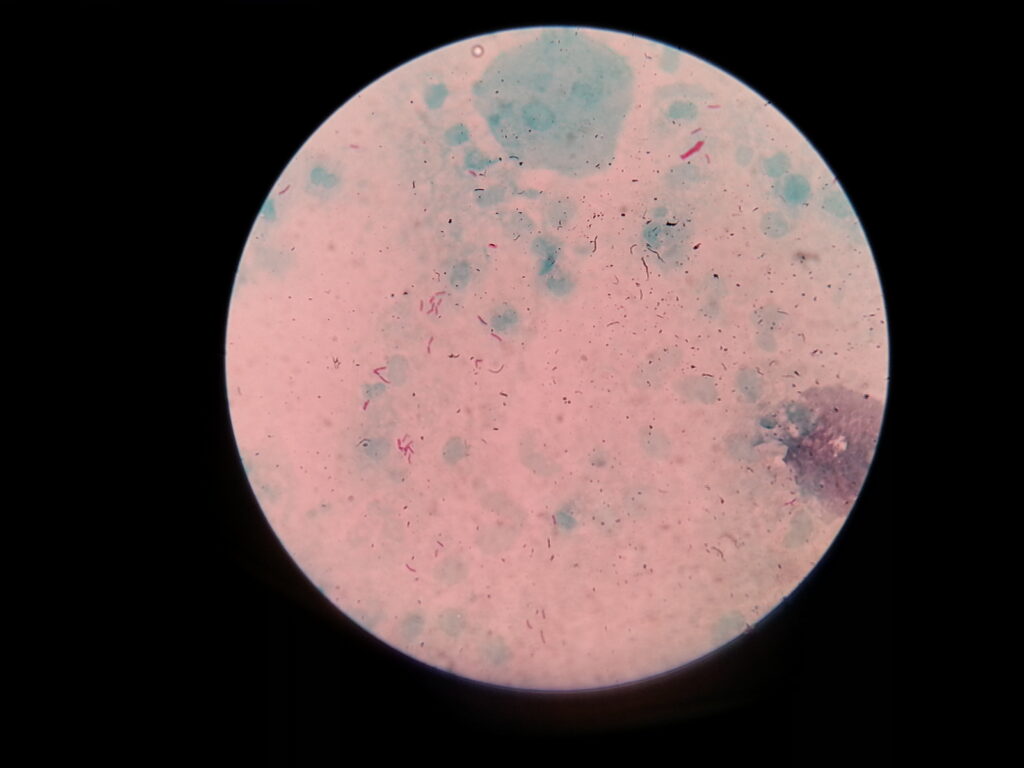 AFB positive smear of Mycobacterium tuberculosis