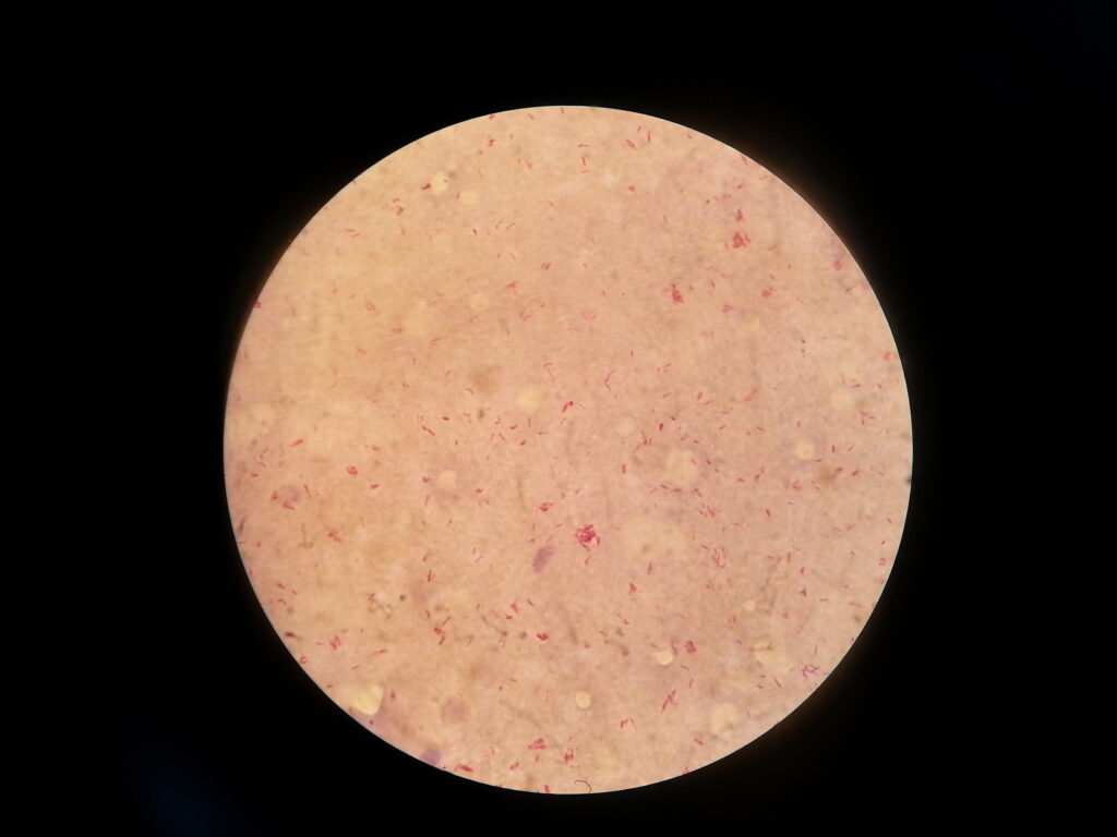 Acid fast bacilli of Mycobacterium leprae in slit kin smear