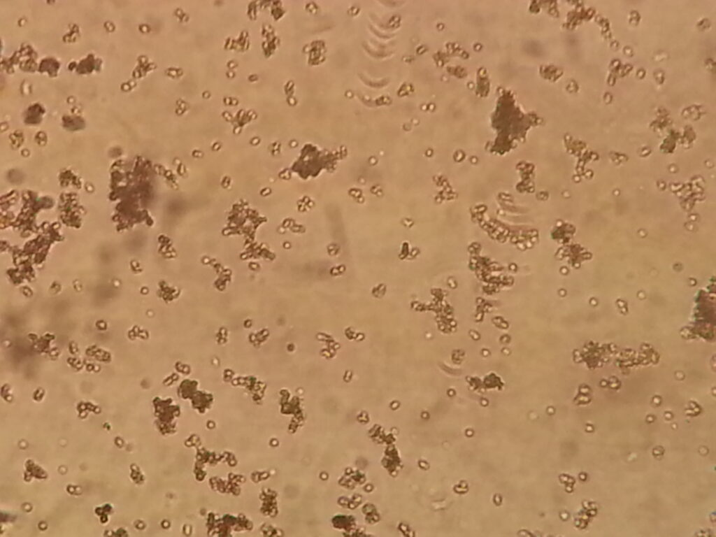 Amorphous urate crystals in Urine