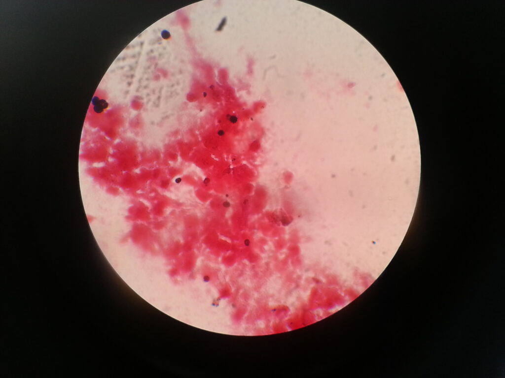 Aspergillus conidia in Gram stained smear of aural discharge of a CSOM patient