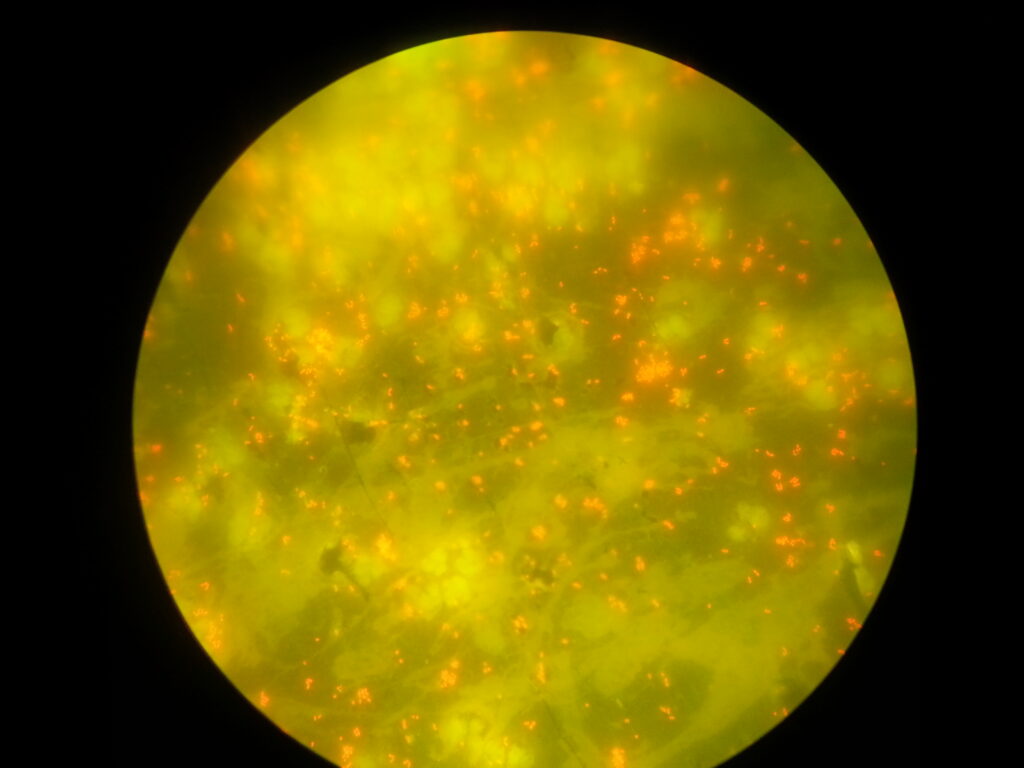 Bacteria in acridine orange stained smear of culture microscopy