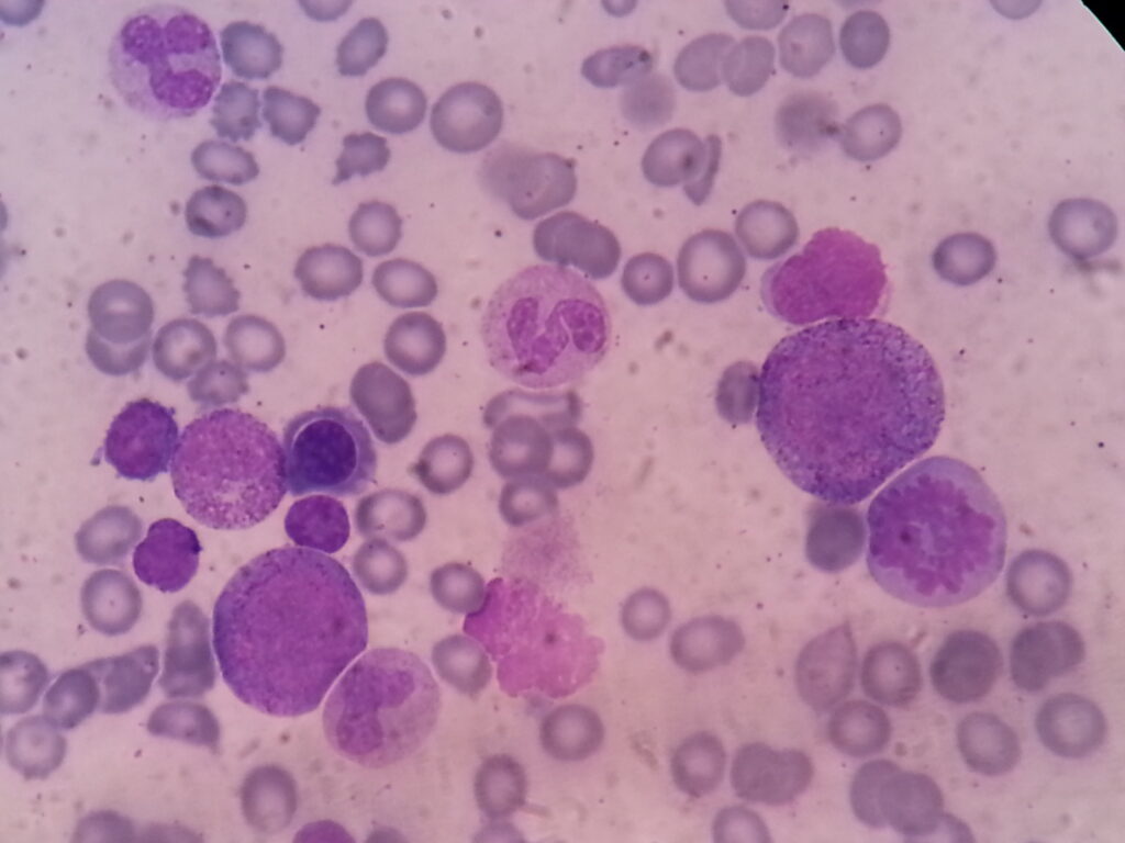 Basophilic myeloblast, promegakaryocyte,megaloblast in Wright stained smear of bone marrow microscopy