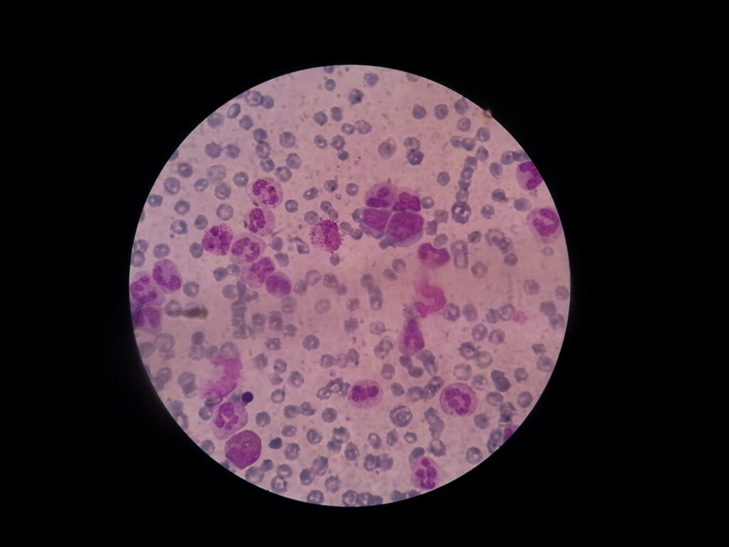 Blast cells on PBS Microscopy of leukemic patient blood