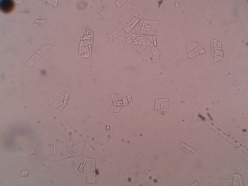 Cholesterol crystals in pleural fluid microscopy