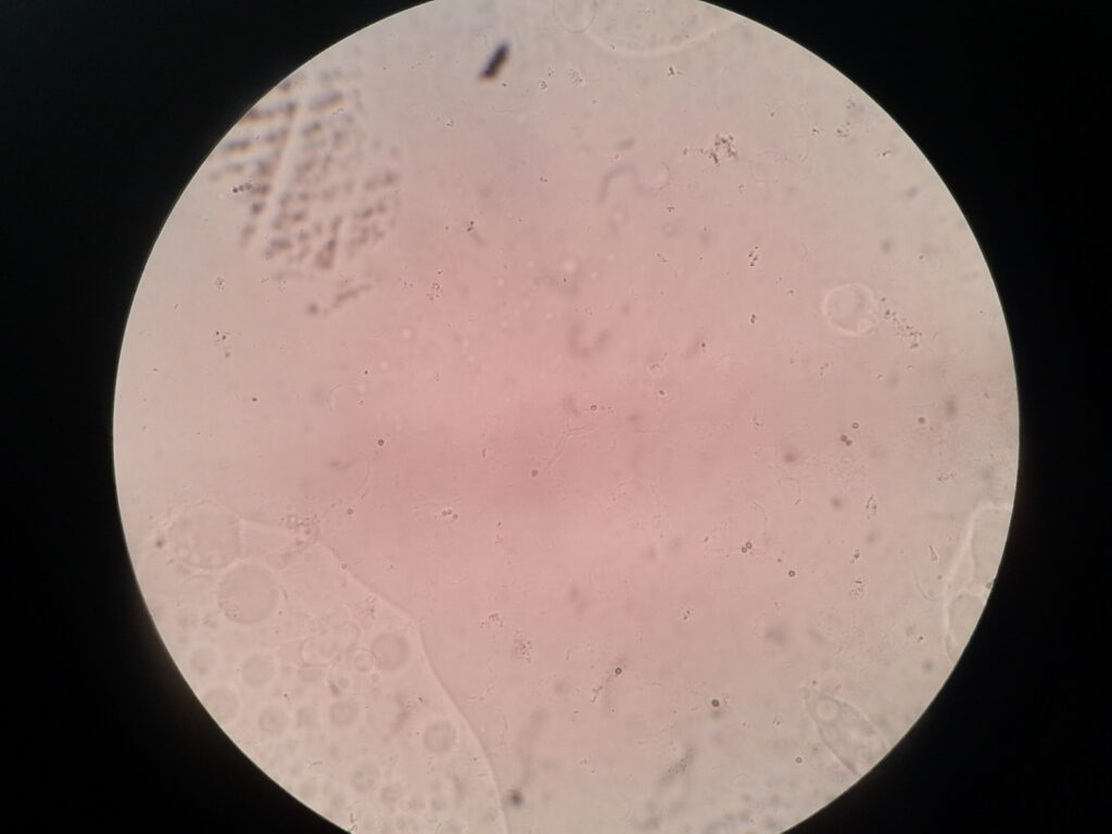 Conidia and hyphae in KOH mount of ear pus